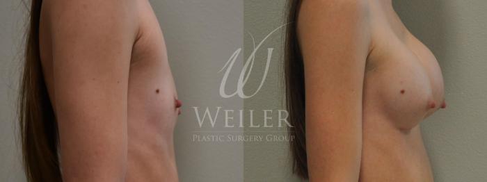 Before & After Breast Augmentation Case 214 View #2 View in Baton Rouge, New Orleans, & Lafayette, Louisiana