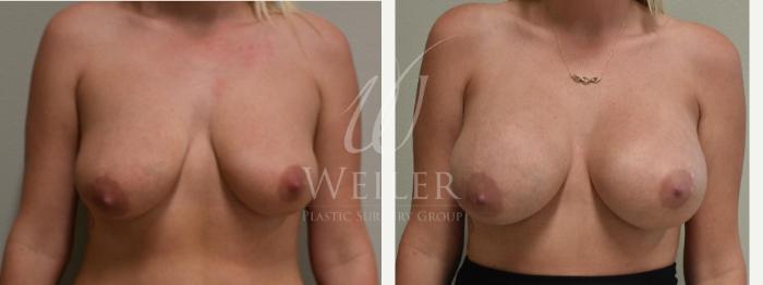 Before & After Breast Augmentation Case 234 View #1 View in Baton Rouge, Louisiana