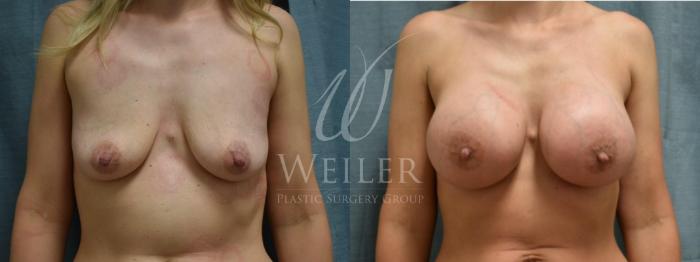 Before & After Breast Augmentation Case 238 View #1 View in Baton Rouge, New Orleans, & Lafayette, Louisiana