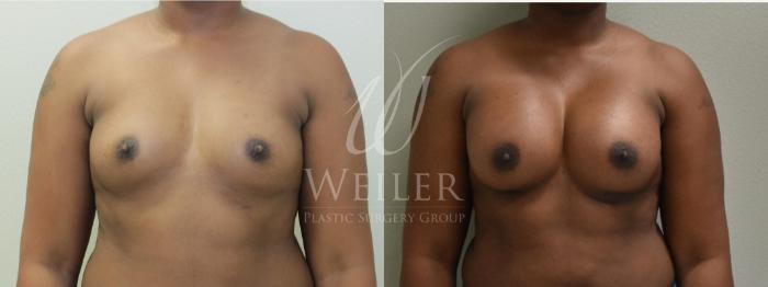 Before & After Breast Augmentation Case 254 View #1 View in Baton Rouge, Louisiana