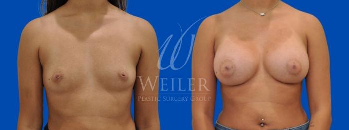 Before & After Breast Augmentation Case 281 View #1 View in Baton Rouge, New Orleans, & Lafayette, Louisiana
