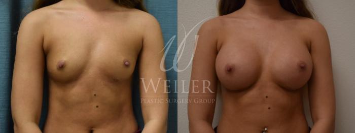 Before & After Breast Augmentation Case 305 View #1 View in Baton Rouge, New Orleans, & Lafayette, Louisiana