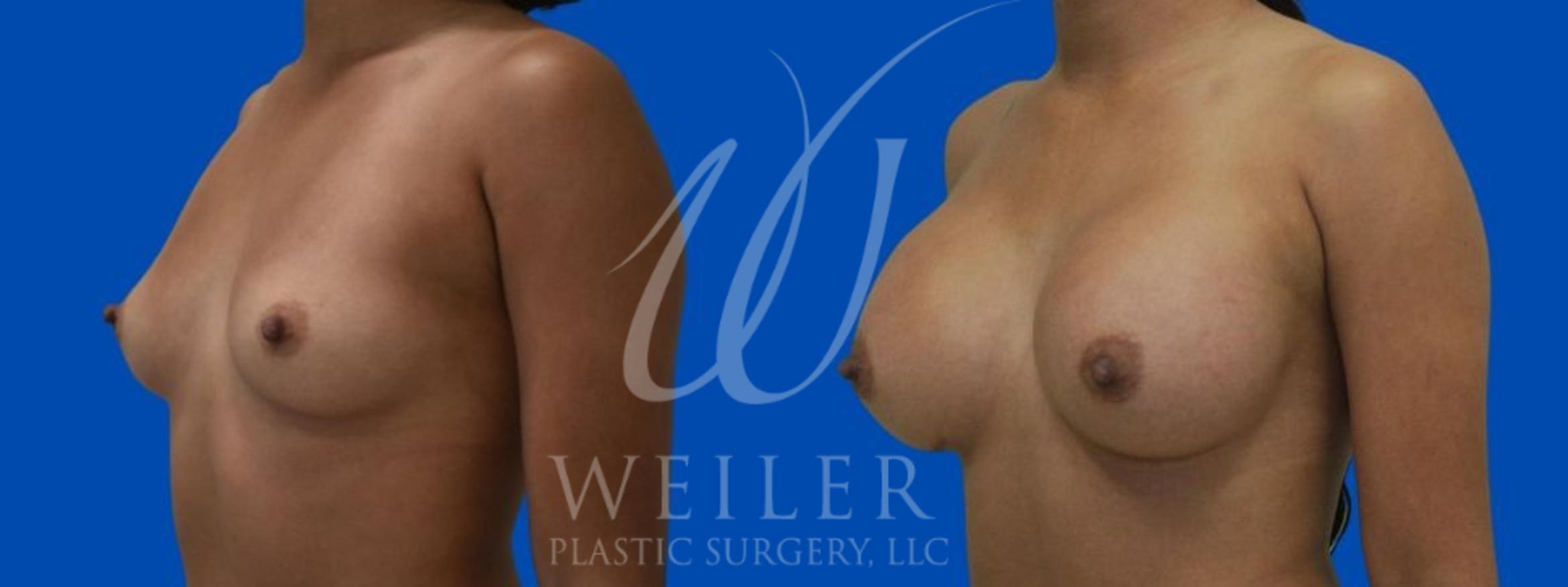 Before & After Breast Augmentation Case 311 View #1 View in Baton Rouge, Louisiana