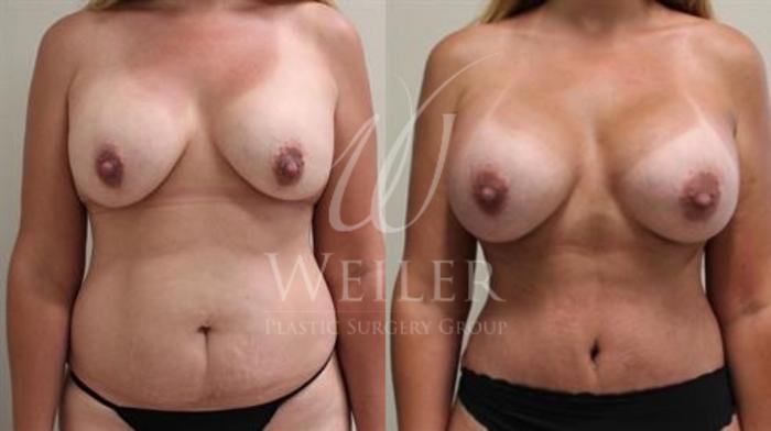 Before & After Breast Augmentation Case 339 View #1 View in Baton Rouge, New Orleans, & Lafayette, Louisiana