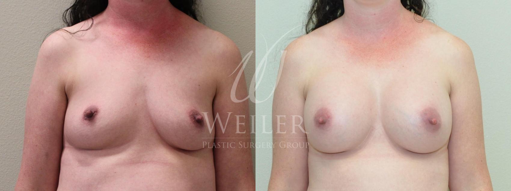 Before & After Breast Augmentation Case 343 Front View in Baton Rouge, New Orleans, & Lafayette, Louisiana