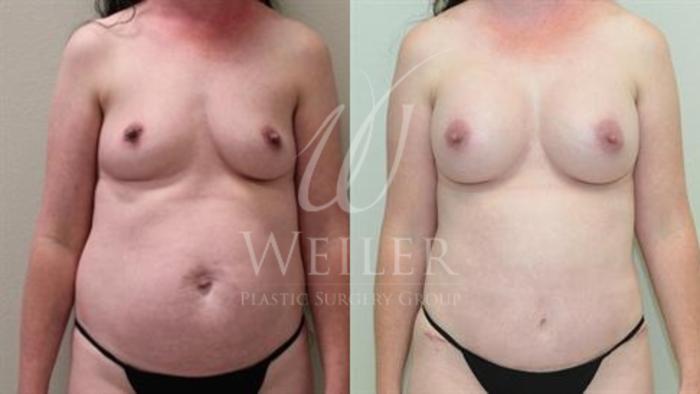 Before & After Breast Augmentation Case 343 View #1 View in Baton Rouge, New Orleans, & Lafayette, Louisiana