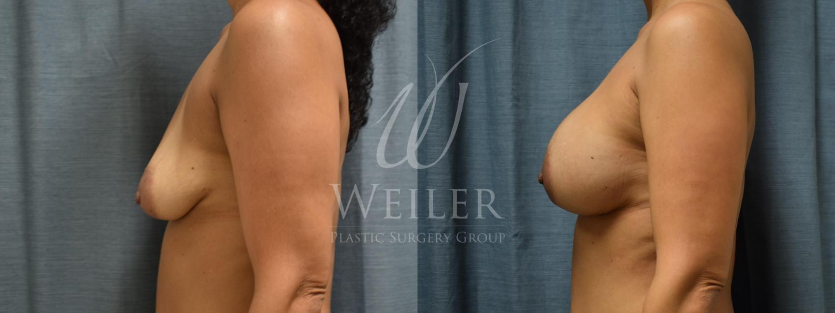 Before & After Breast Augmentation Case 361 View #1 View in Baton Rouge, New Orleans, & Lafayette, Louisiana