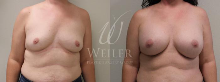 Before & After Breast Augmentation Case 371 View #1 View in Baton Rouge, Louisiana