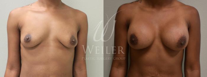 Before & After Breast Augmentation Case 372 View #1 View in Baton Rouge, New Orleans, & Lafayette, Louisiana