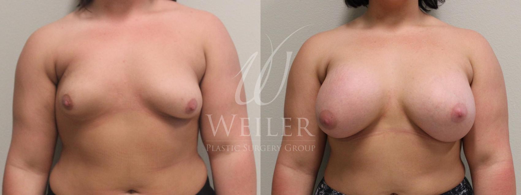 Before & After Breast Augmentation Case 373 View #1 View in Baton Rouge, New Orleans, & Lafayette, Louisiana