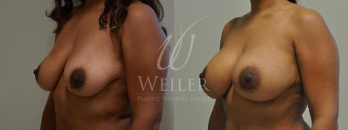 Before & After Breast Augmentation Case 374 View #2 View in Baton Rouge, New Orleans, & Lafayette, Louisiana