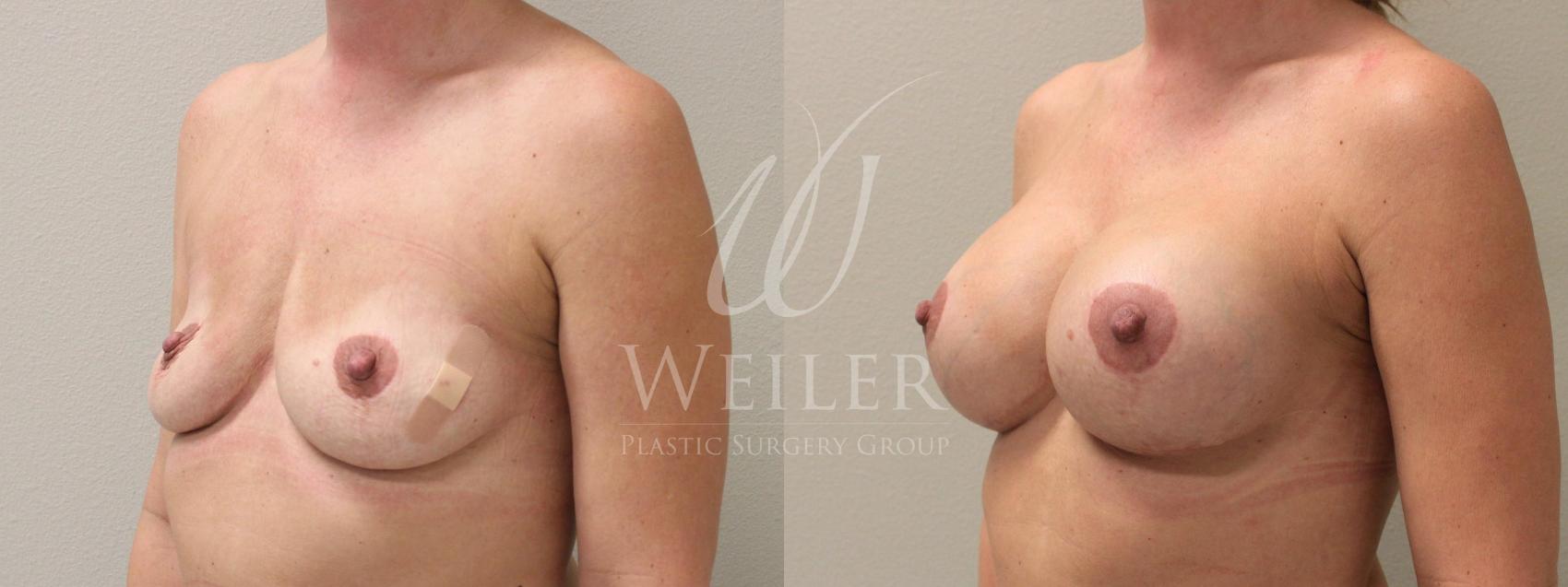 Before & After Breast Augmentation Case 375 View #1 View in Baton Rouge, Louisiana