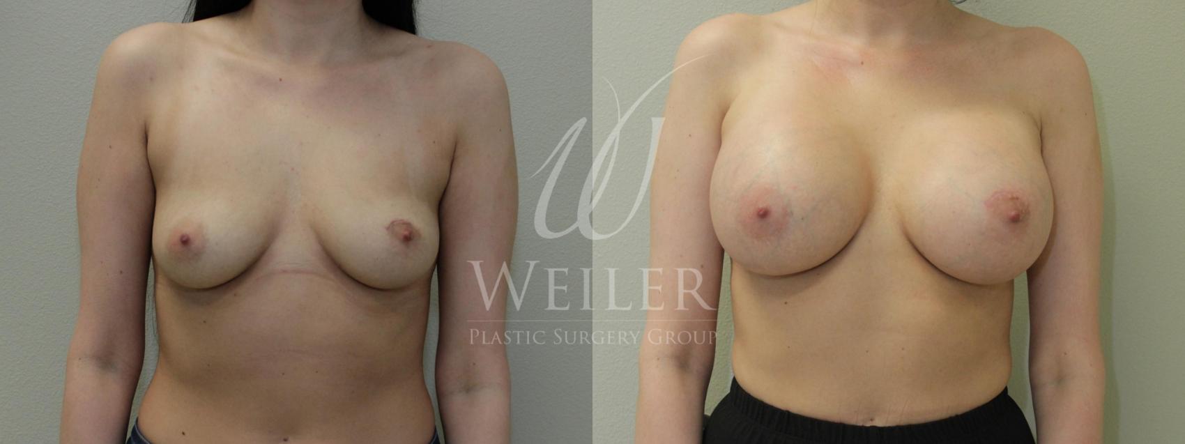 Before & After Breast Augmentation Case 387 View #1 View in Baton Rouge, New Orleans, & Lafayette, Louisiana