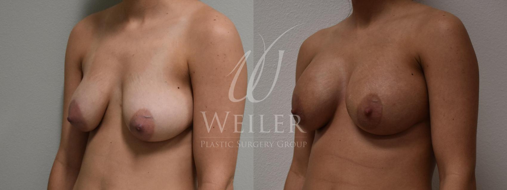 Before & After Breast Augmentation Case 422 View #1 View in Baton Rouge, New Orleans, & Lafayette, Louisiana