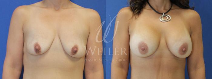 Before & After Breast Augmentation Case 470 Front View in Baton Rouge, Louisiana