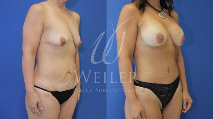 Before & After Breast Augmentation Case 470 Right Oblique View in Baton Rouge, Louisiana