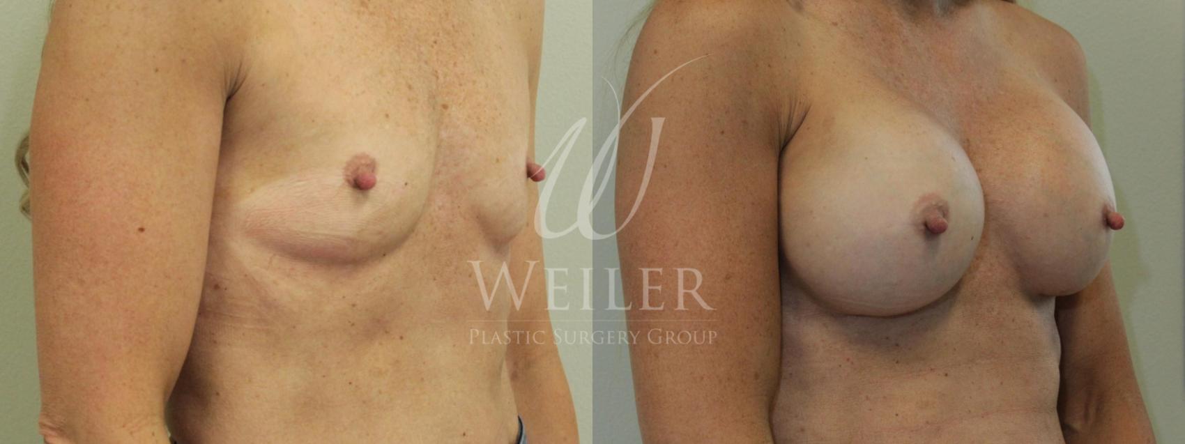Before & After Breast Augmentation Case 472 View 1 View in Baton Rouge, New Orleans, & Lafayette, Louisiana