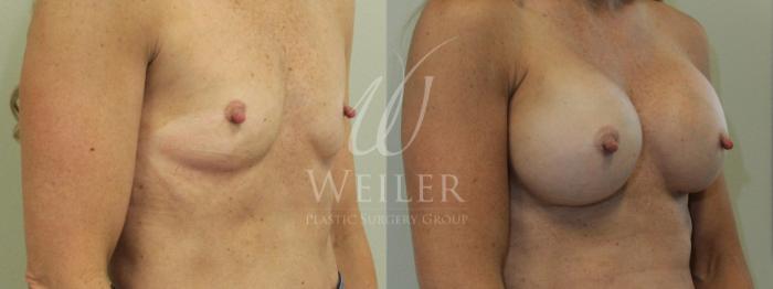Before & After Breast Augmentation Case 472 View 1 View in Baton Rouge, New Orleans, & Lafayette, Louisiana