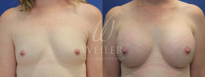 Before & After Breast Augmentation Case 507 Front View in Baton Rouge, Louisiana