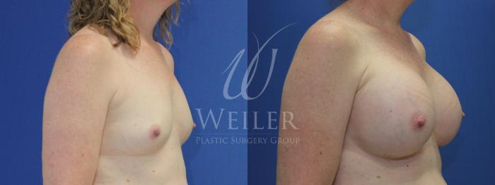 Before & After Breast Augmentation Case 507 Right Oblique View in Baton Rouge, New Orleans, & Lafayette, Louisiana