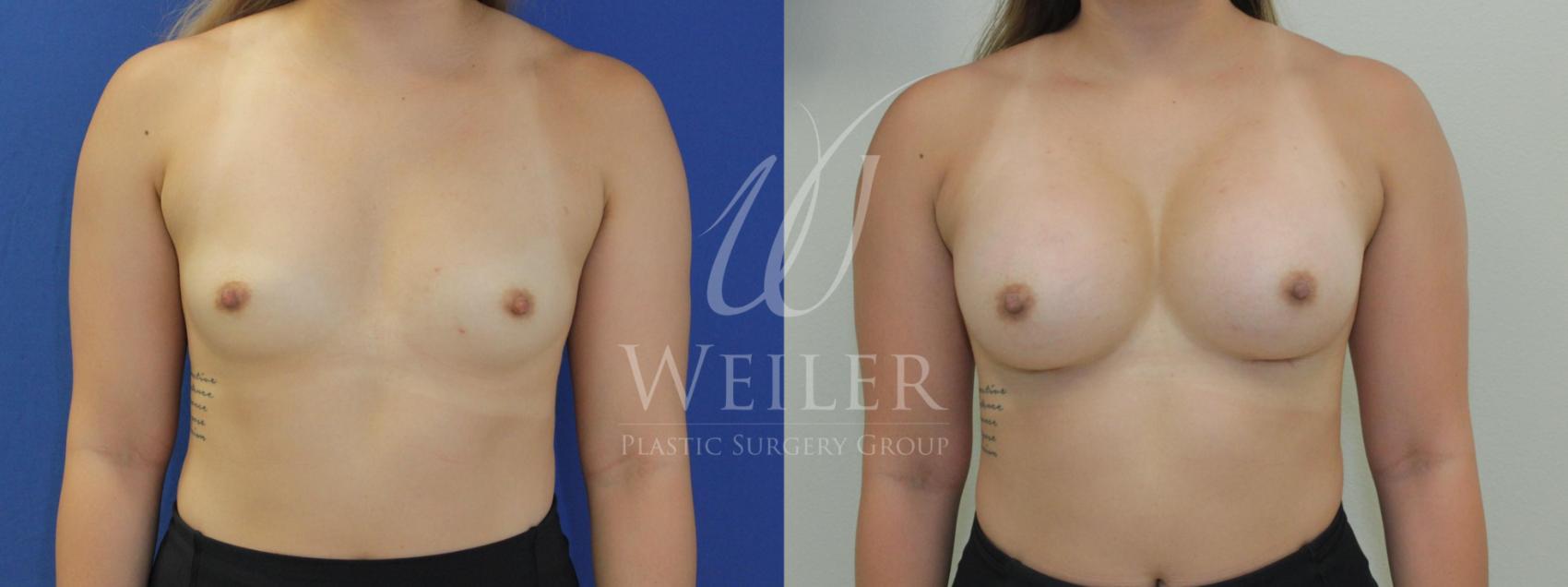 Before & After Breast Augmentation Case 541 Front View in Baton Rouge, Louisiana