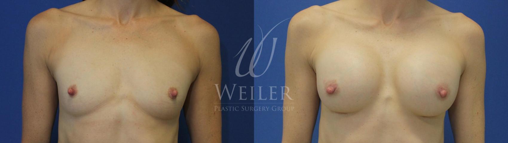 Before & After Breast Augmentation Case 572 Front View in Baton Rouge, New Orleans, & Lafayette, Louisiana