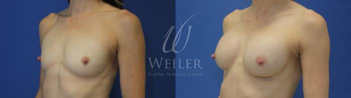 Before & After Breast Augmentation Case 572 Left Oblique View in Baton Rouge, New Orleans, & Lafayette, Louisiana