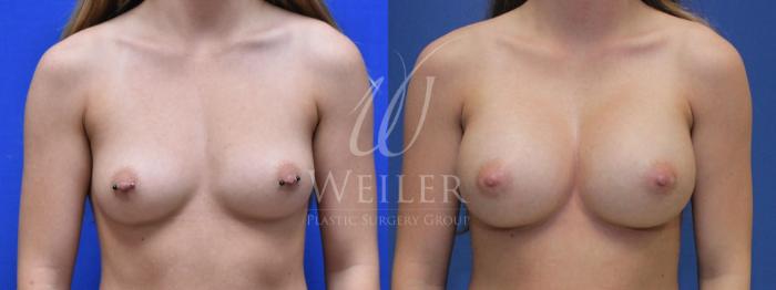 Before & After Breast Augmentation Case 593 Front View in Baton Rouge, Louisiana