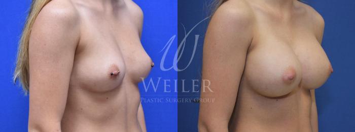 Before & After Breast Augmentation Case 593 Right Side View in Baton Rouge, New Orleans, & Lafayette, Louisiana