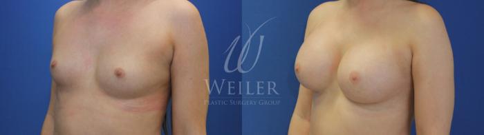 Before & After Breast Augmentation Case 623 Left Oblique View in Baton Rouge, Louisiana