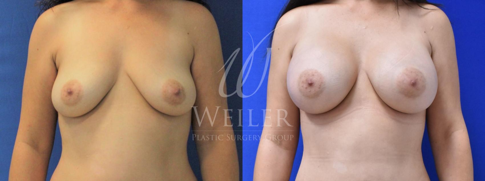 Before & After Breast Augmentation Case 634 Front View in Baton Rouge, New Orleans, & Lafayette, Louisiana