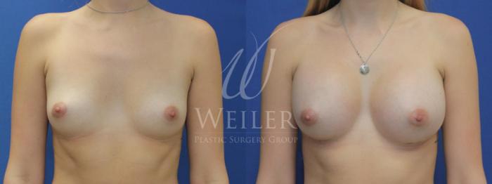 Before & After Breast Augmentation Case 653 Front View in Baton Rouge, New Orleans, & Lafayette, Louisiana
