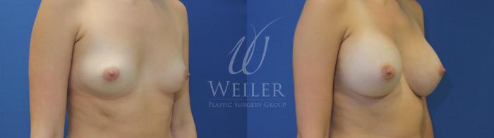 Before & After Breast Augmentation Case 653 Right Oblique View in Baton Rouge, New Orleans, & Lafayette, Louisiana