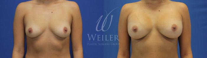 Before & After Breast Augmentation Case 661 Front View in Baton Rouge, Louisiana
