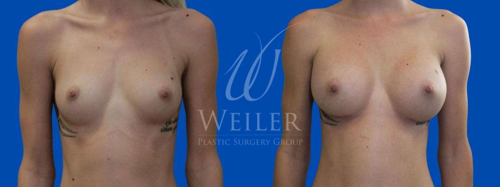 Before & After Breast Augmentation Case 669 Front View in Baton Rouge, New Orleans, & Lafayette, Louisiana