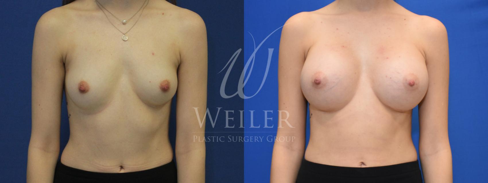 Before & After Breast Augmentation Case 671 Front View in Baton Rouge, Louisiana