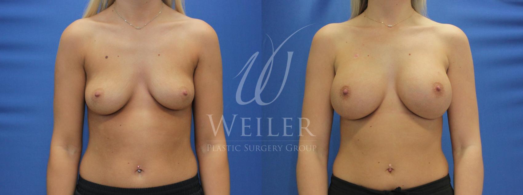 Before & After Breast Augmentation Case 693 Front View in Baton Rouge, Louisiana