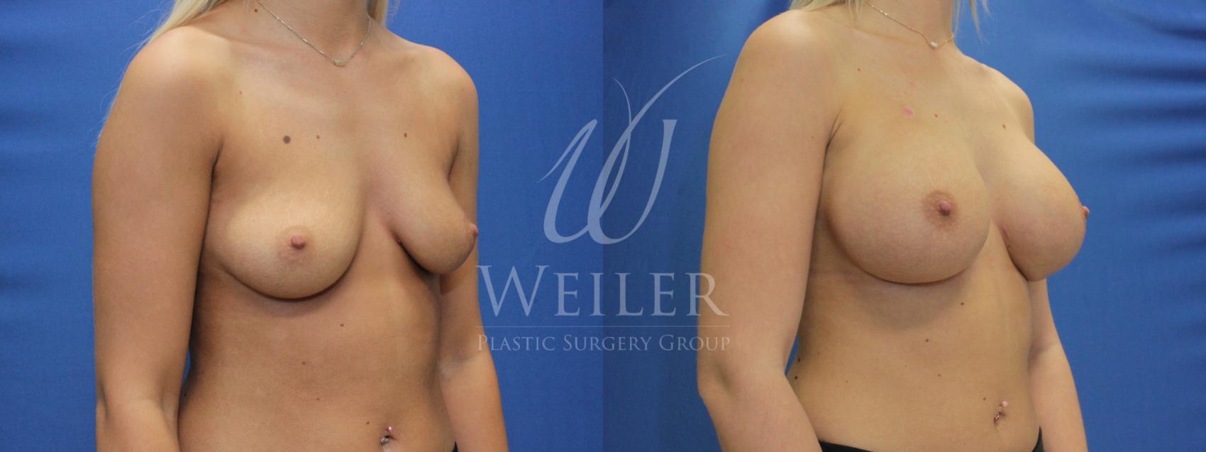 Before & After Breast Augmentation Case 693 Right Oblique View in Baton Rouge, Louisiana