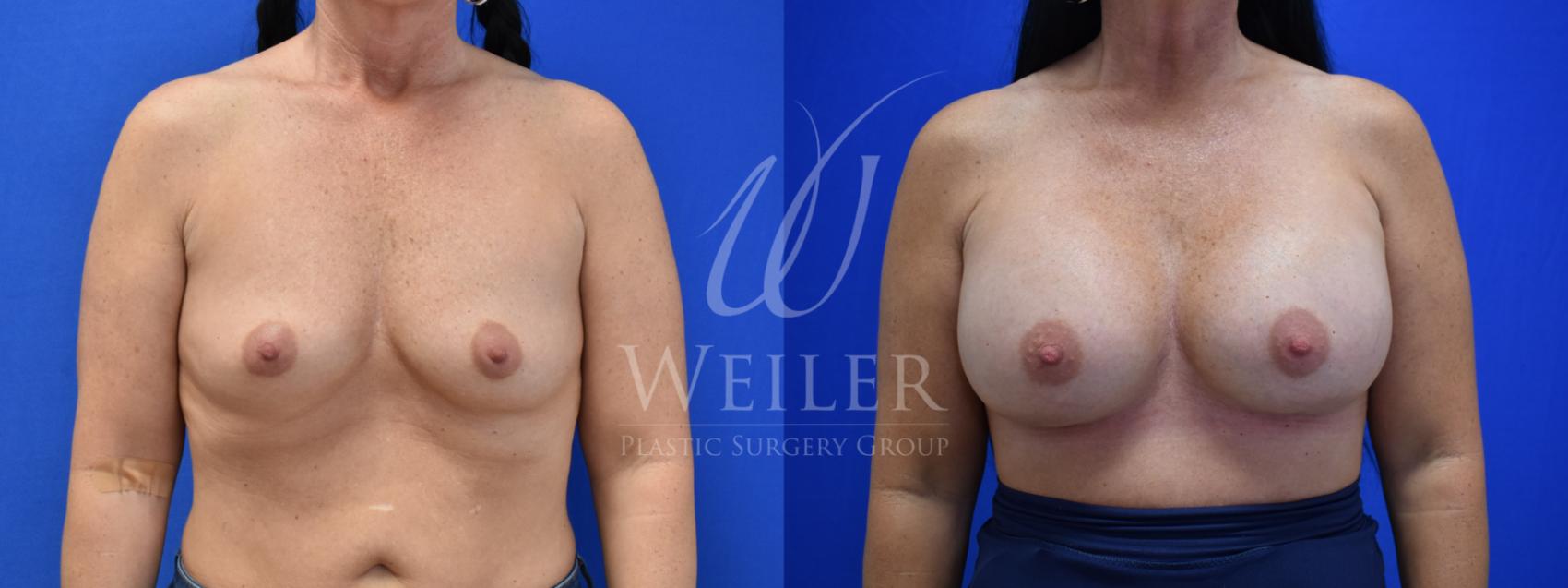 Before & After Breast Augmentation Case 733 Front View in Baton Rouge, Louisiana