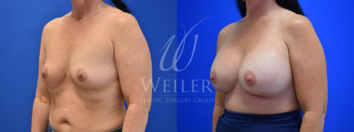 Before & After Breast Augmentation Case 733 Left Side View in Baton Rouge, Louisiana