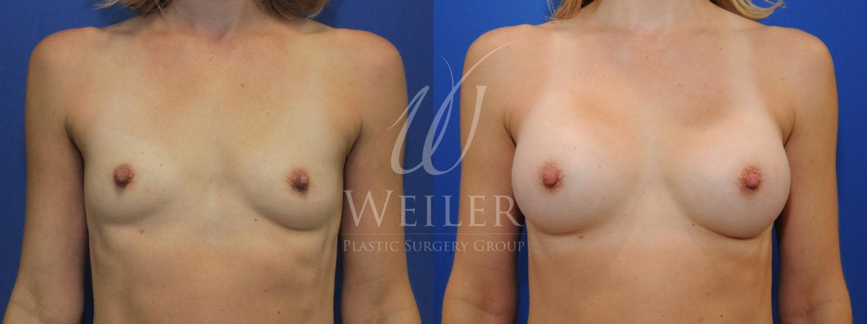 Before & After Breast Augmentation Case 769 Front View in Baton Rouge, Louisiana