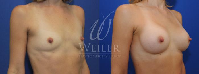 Before & After Breast Augmentation Case 769 Right Side View in Baton Rouge, New Orleans, & Lafayette, Louisiana