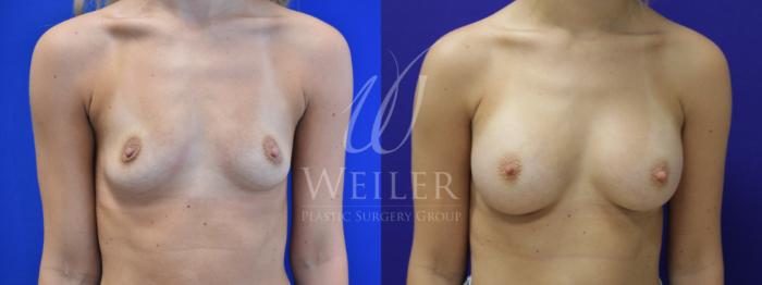 Before & After Breast Augmentation Case 770 Front View in Baton Rouge, New Orleans, & Lafayette, Louisiana