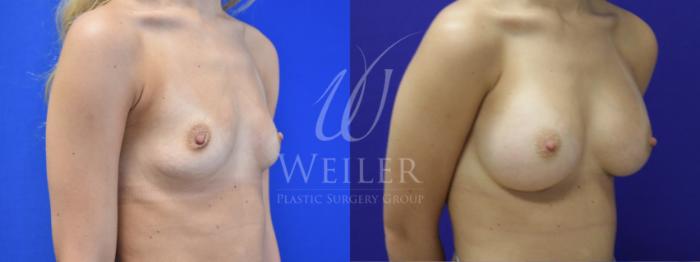 Before & After Breast Augmentation Case 770 Right Side View in Baton Rouge, New Orleans, & Lafayette, Louisiana