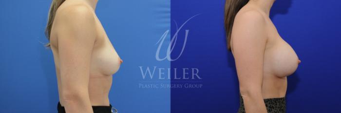 Before & After Breast Augmentation Case 777 Right Side View in Baton Rouge, Louisiana