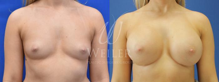 Before & After Breast Augmentation Case 790 Front View in Baton Rouge, Louisiana