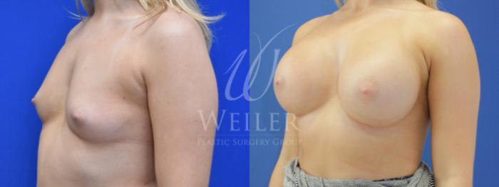 Before & After Breast Augmentation Case 790 Left Oblique View in Baton Rouge, Louisiana