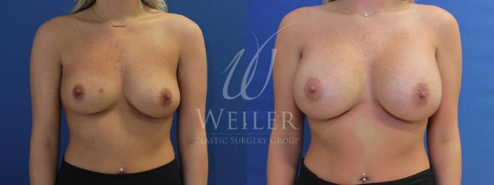 Before & After Breast Augmentation Case 791 Front View in Baton Rouge, Louisiana