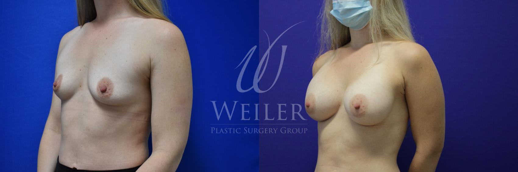 Before & After Breast Augmentation Case 793 Left Oblique View in Baton Rouge, Louisiana