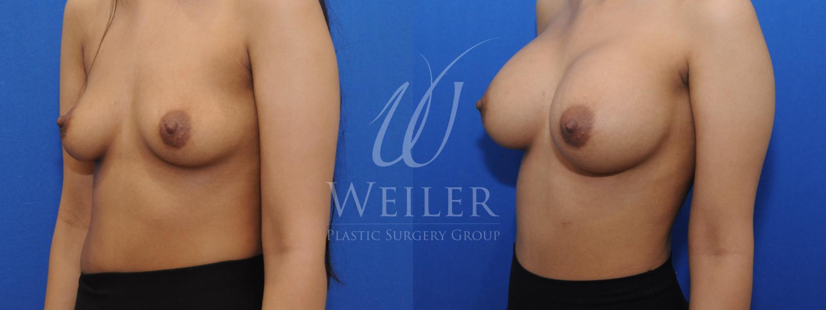 Before & After Breast Augmentation Case 813 Left Oblique View in Baton Rouge, Louisiana
